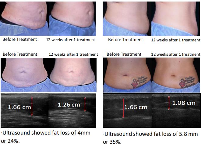 Trusculpt 3DモノポーラRfホットスカルプティング脂肪溶解高周波脂肪燃焼ボディコントゥアリング機器